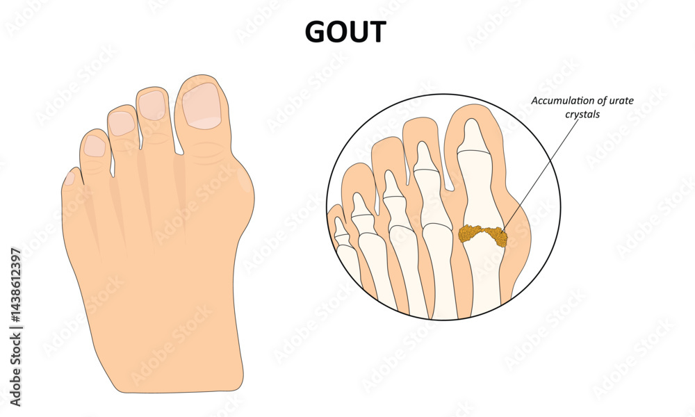 Fototapeta premium Gout foot disease vector illustration