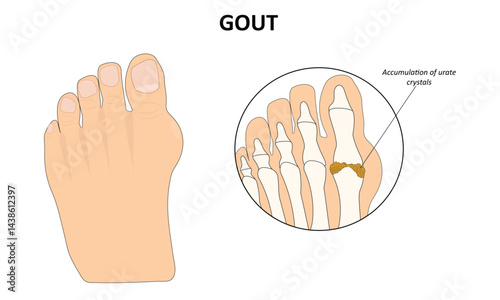 Gout foot disease vector illustration