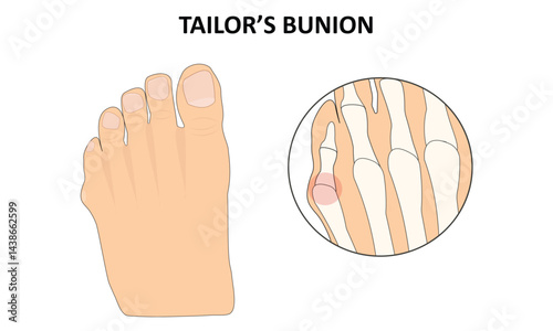 Tailor's bunion vector illustration