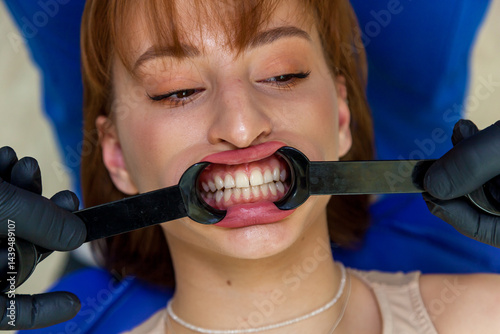 Close-up of a woman lying in a dental chair with a cheek retractor in her mouth, exposing her clean teeth for examination by a dentist wearing black gloves