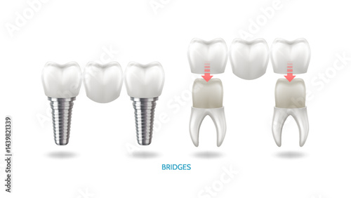 realism-set-teeth-different-types-dental-problems
