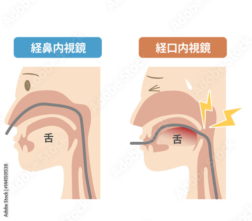 胃カメラの鼻から入れる経鼻内視鏡と口から入れる経口内視鏡の違いの説明図