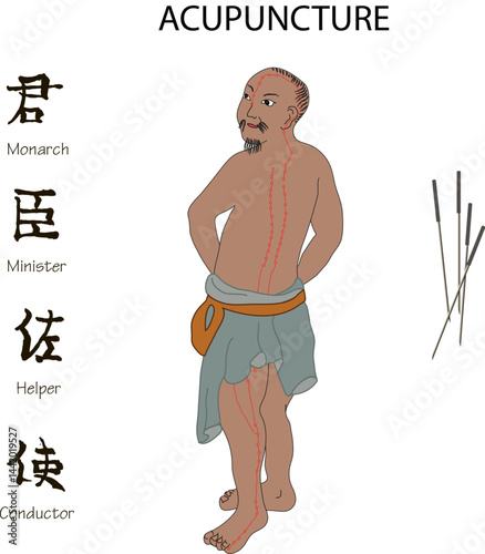 Chinese medicine acupuncture vector illustration. Traditional healing with acupunctural needles on man's body. Holistic health treatment.