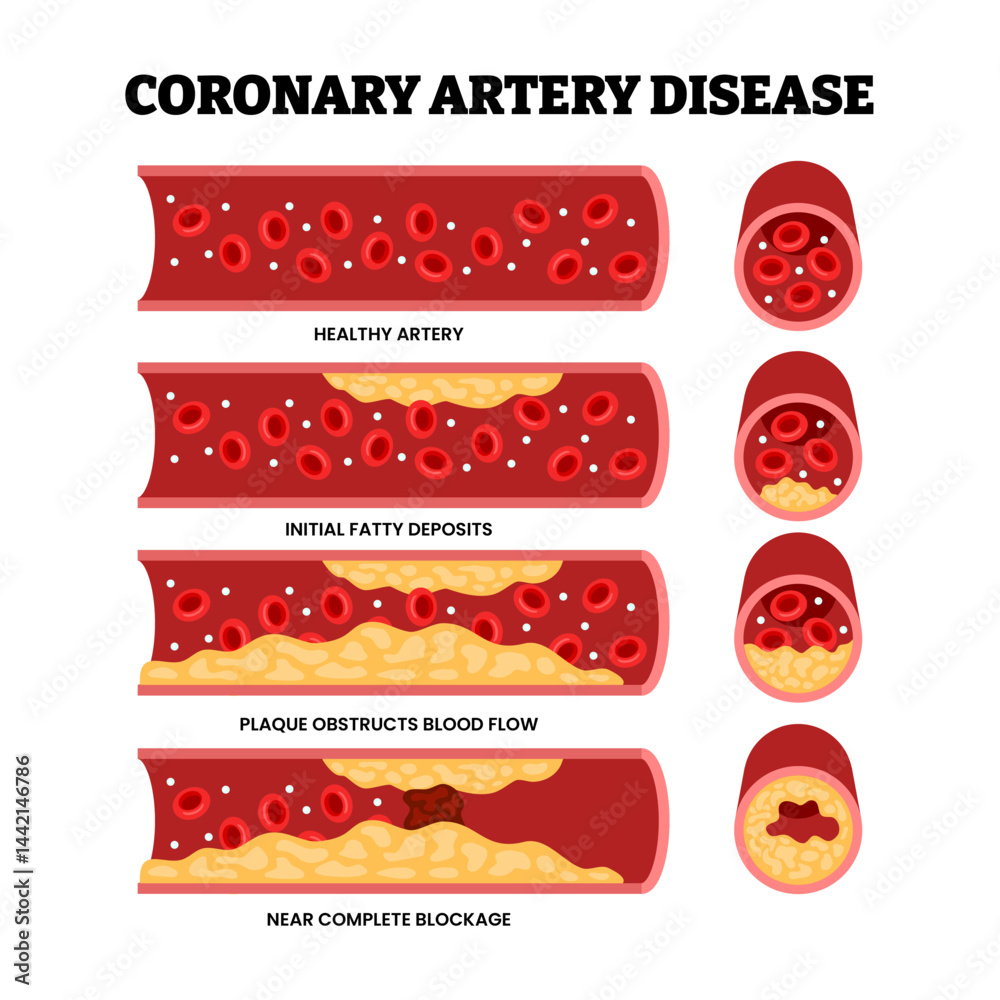 Ταπετσαρία Different types of coronary artery disease types as a chest heart problem, educational medical poster design healthcare scheme, labeled initial fatty deposits, plaque obstruction blood flow blockage