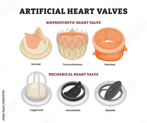 Different types of artificial heart valve, educational medical poster design healthcare, labeled bioprosthetic (stented, transcutaneous, stentless), mechanical (caged ball, monoleaflet, bileaflet.