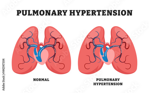 Pulmonary Hypertension with narrow arteries and blockage, educational medical poster design healthcare scheme, labeled comparison with healthy lungs and respiratory system disease illustration.