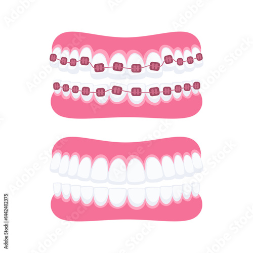Orthodontic treatment showing teeth with and without braces