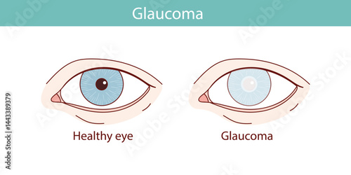glaucoma eye vector anatomical illustration