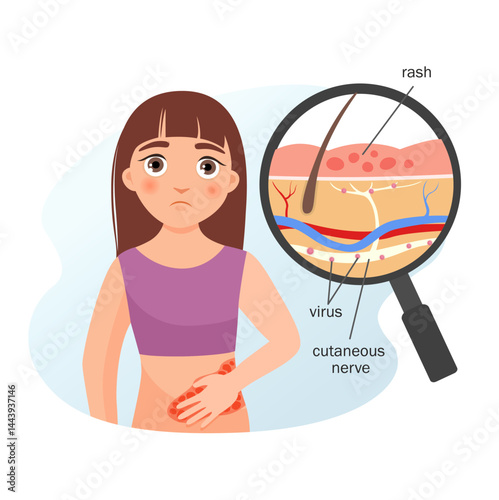 Vector medical poster shingles. Cartoon illustration cute girl with shingles. Skin diagram with zoster virus.
