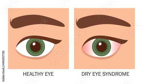 Vector medical poster healthy eye and dry eye syndrome. Redness of the eyes, fatigue, irritation of the conjunctiva.
