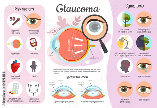 Vector infographics glaucoma. Medical poster of eye disease. Anatomy of the eyeball. Causes and symptoms of the disease.
