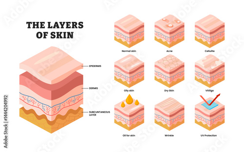 Different types of layer skins structure anatomy with isometric view,  educational medical poster design healthcare scheme, labeled acne, cellulite, oily, dry, vitiligo, wrinkle, uv protection.