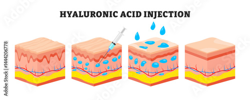 Steps of Hyaluronic acid injection steps progress, medical poster design healthcare scheme, labeled skincare products. skin rejuvenation with help of hyaluronic acid. Cross section skin layers.