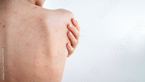 female back and shoulders of a woman with pimples and acne on skin on a white isolated background. Body of a girl with problematic skin