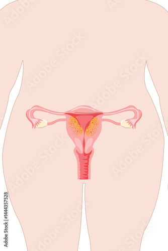 Diagram showing adenomyosis condition in uterus, with abnormal tissue growth inside muscle wall