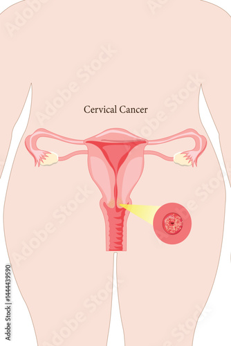 Medical illustration of cervical cancer in female reproductive system, highlighted close-up view.
