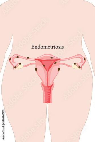 Medical illustration of endometriosis showing abnormal tissue growth in female reproductive organs