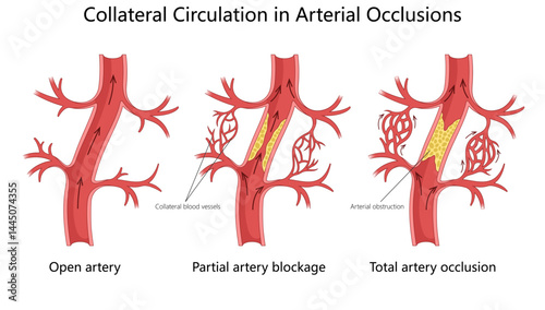 blood flow changes in artery from open flow to partial blockage and total occlusion, highlighting collateral circulation diagram hand drawn schematic vector illustration. Medical science educational