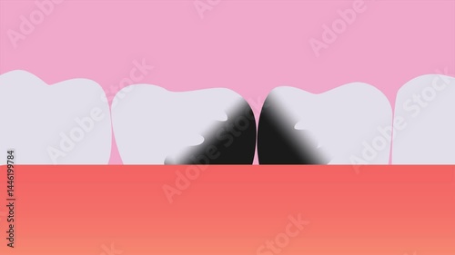 The appearance of caries on teeth. Animation 2D