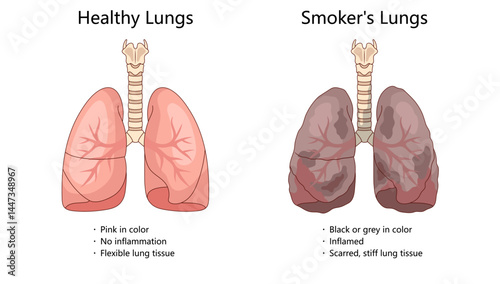healthy pink lungs with blackened, inflamed smoker lungs, highlighting the damage smoking causes to lung tissue and health diagram hand drawn schematic vector illustration. Medical science educational