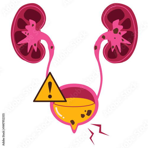 Bladder disease. Bladder stones illustration 