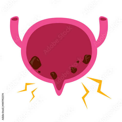 Bladder disease. Bladder stones illustration 