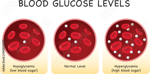 Glucose in the blood vessel. normal level, hyperglycemia (high blood sugar), hypoglycemia (low blood sugar). Vector illustration