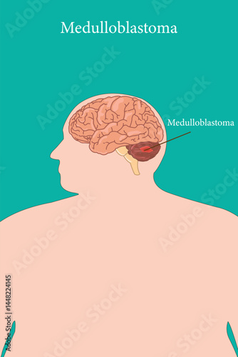 Brain diagram showing medulloblastoma tumor location inside overweight man silhouette.