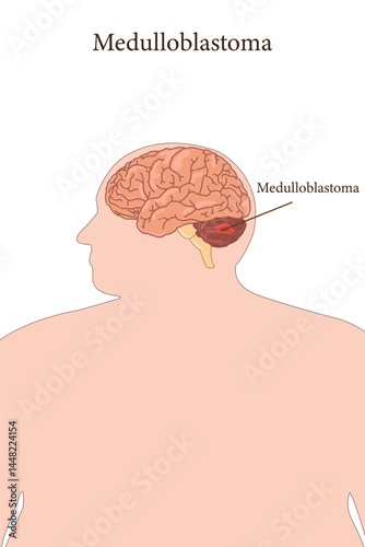 Medical illustration of medulloblastoma brain tumor in obese male human anatomy.