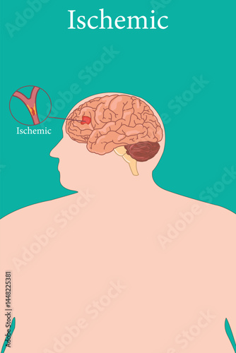 Illustration of ischemic stroke showing brain artery blockage and affected brain area.
