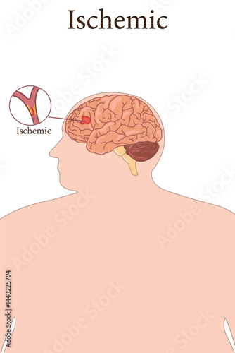 Medical diagram of ischemic stroke with blocked artery and brain tissue damage.
