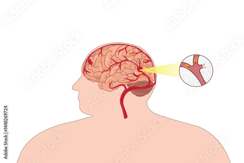Illustration of brain ischemic stroke with artery blockage in overweight male.