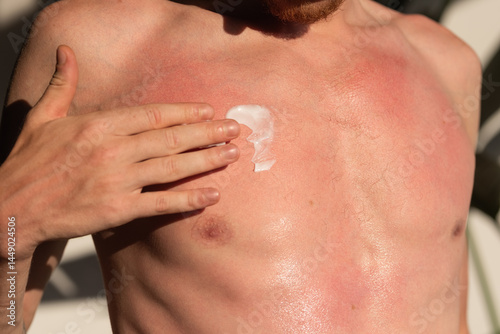 Man applying lotion to relieve sunburn