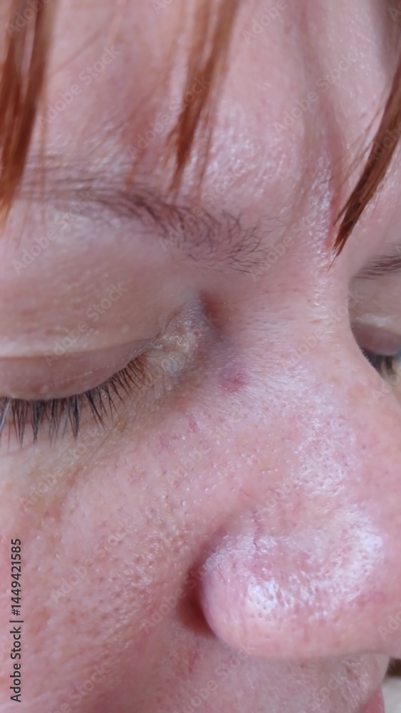 Naklejka premium Spot on the face after removal of papilloma (a week ago)