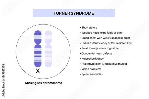 Turner syndrome poster