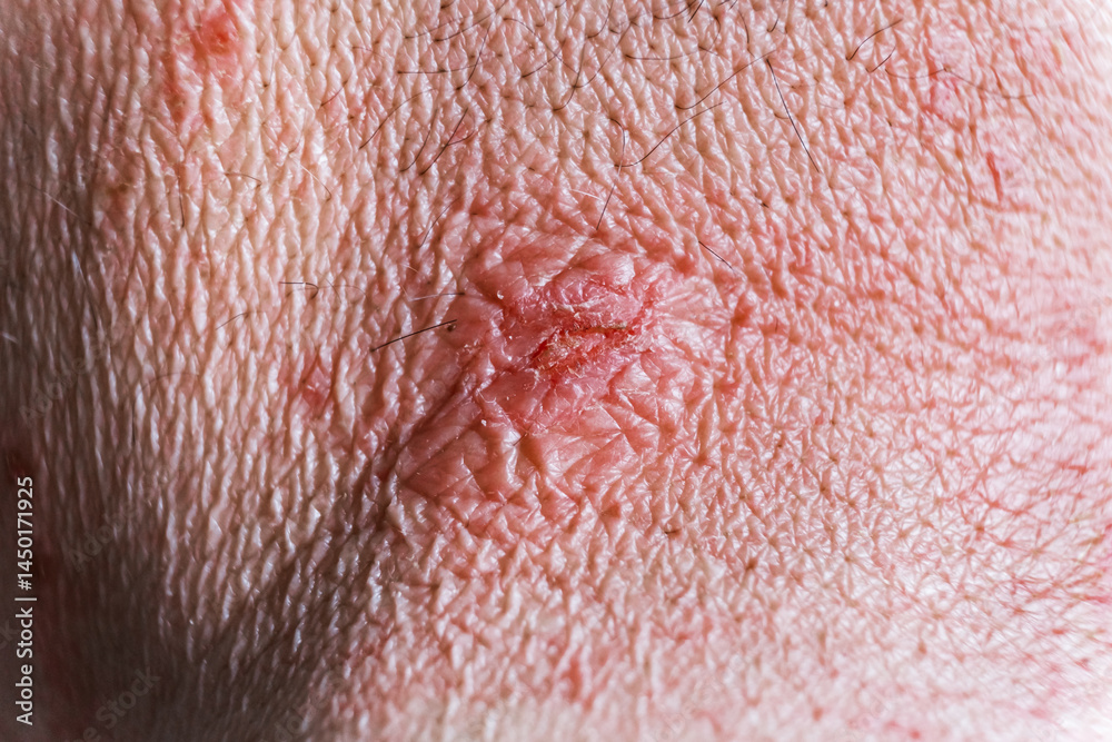Fototapeta premium Skin lesion symptom in Shingles or Herpes zoster in person. Viral disease Varicella virus. Painful skin rash with blisters on the body. Red pimples. Insects bite. Body injury. High quality photo.
