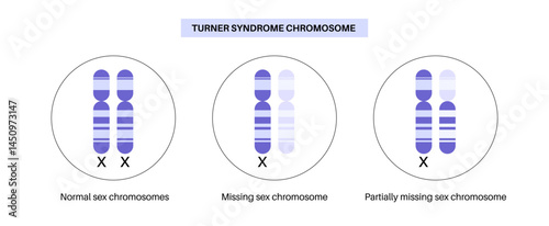 Turner syndrome poster