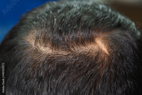 Bald spot on head showing thinning hair and light scalp
