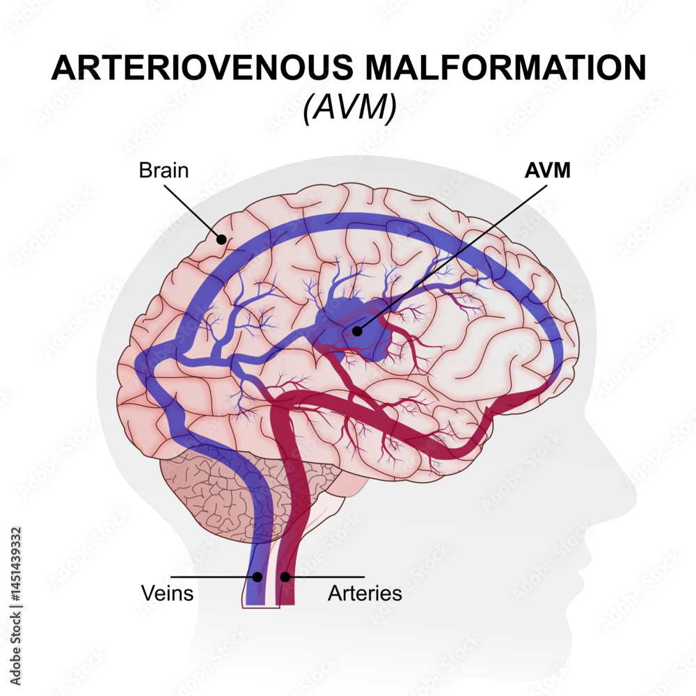 Fototapeta premium Arteriovenous Malformation (AVM) Brain Illustration
