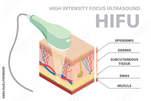 High intensity focus ultrasound (HIFU). SMAS ultrasound face lifting. Face saggy skin treat. Body lift. Double chin lift. Facial medical procedure. 3d flat isometric vector cutaway skin diagram.