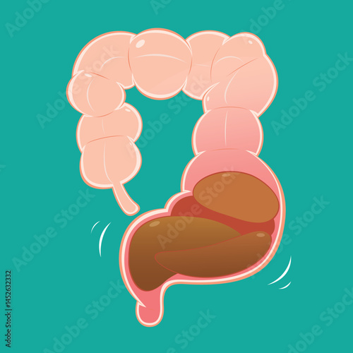 A charming illustration of intestines suffering from constipation.