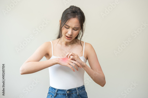 Dermatology asian young woman allergy, allergic reaction from atopic, insect bite, scratching itchy back of hand, red spot or rash of skin. Healthcare treatment of beauty. Isolated on white background