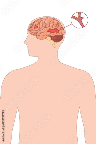 Brain hemorrhage vector illustration showing internal bleeding, stroke concept in human silhouette