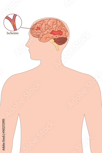 Ischemic stroke brain diagram showing blocked artery in human head silhouette illustration. eps 10