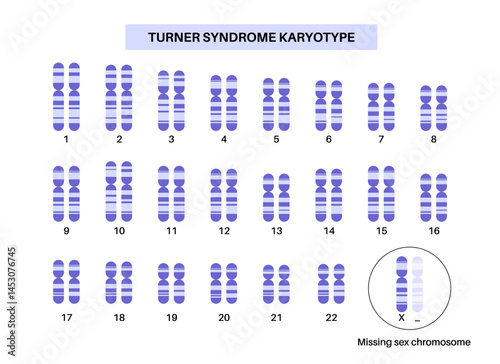 Turner syndrome poster