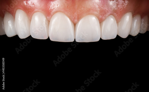 ceramic crowns and veneers