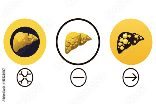 Medical vector icons depicting liver damage stages fatty liver, fibrosis, and cirrhosis, highlighting the impact of liver diseases medical virus icon set