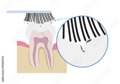 Ineffective toothbrushing: food residue trapped in enamel grooves. Tooth enamel microstructure prevents complete cleaning with standard brush