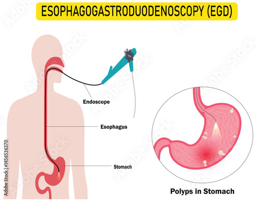 esophagogastroduodenoscopy medical procedure for Diagnosing Stomach and Duodenum Conditions