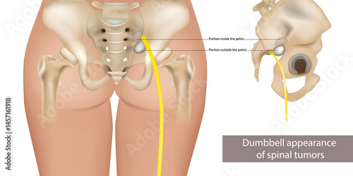 Dumbbell-Shaped Spinal Tumor Illustration with Pelvic Involvement. Medical Diagram of Nerve Root Tumor in Dumbbell Configuration. Anatomical Representation of Spine Tumor Extending Through Pelvis